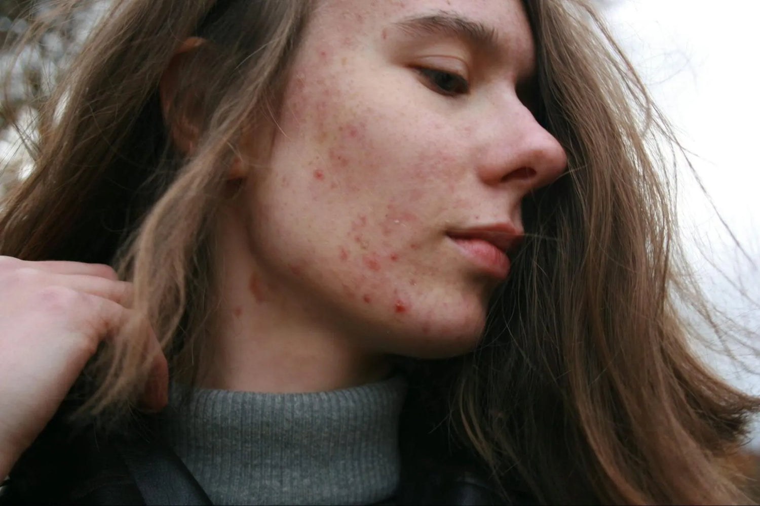 Can Collagen Supplements Cause Acne?