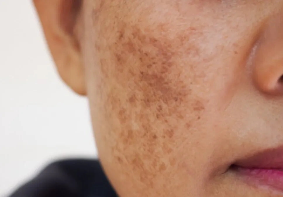 Can Red Light Therapy Worsen Hyperpigmentation?