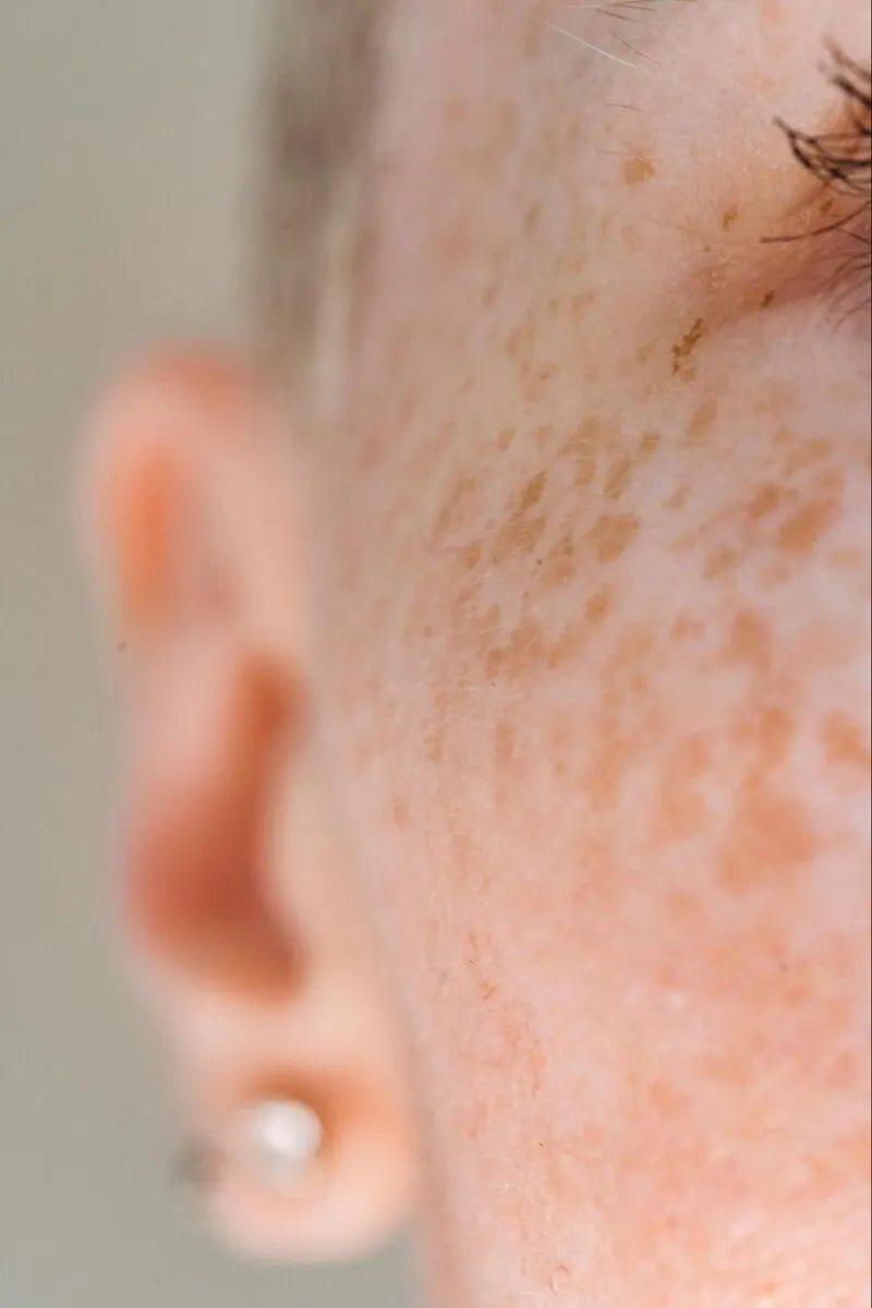 Identifying and Treating Uneven Skin Tone